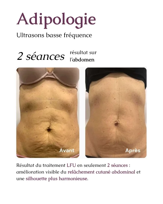 résultat adipologie